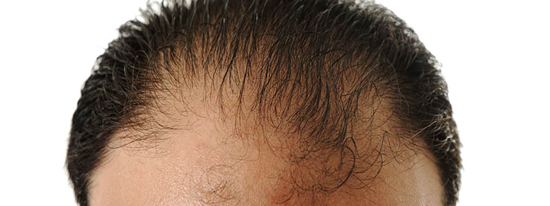 teenage hair loss - tips for coping