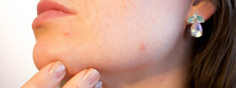 laser treatment for acne scars