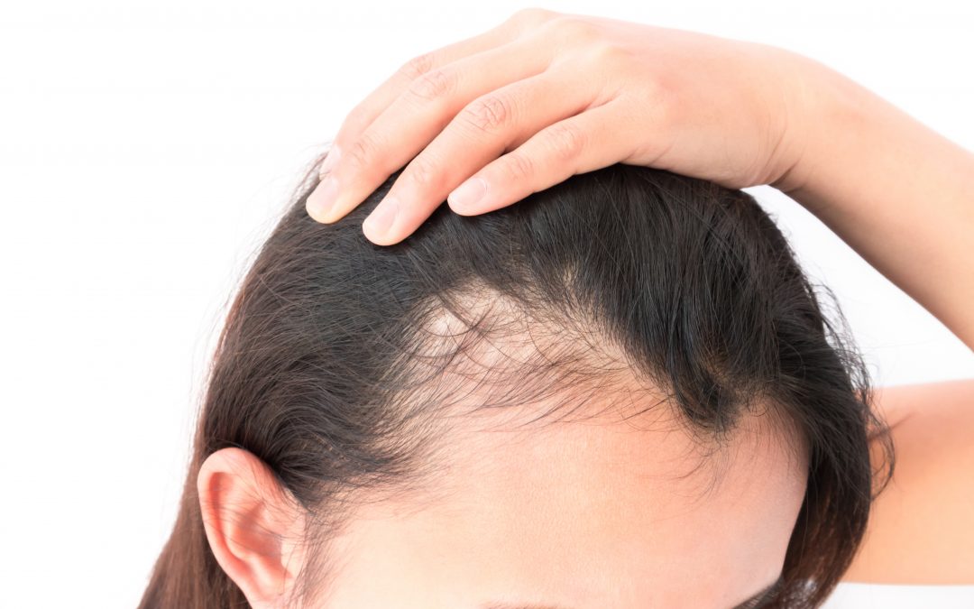 Premature Hair Loss in Women